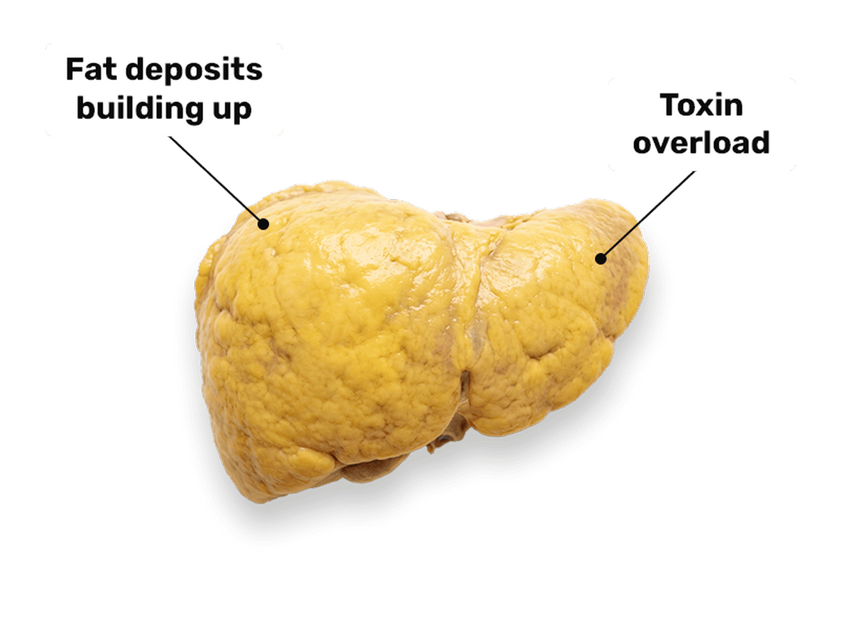 Fatty liver — fat deposits building up, toxin overload