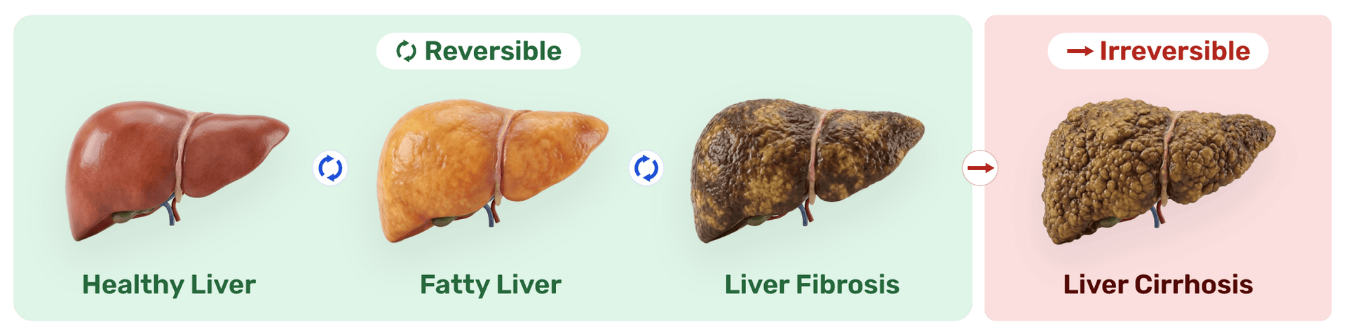 Fatty Liver Builds Silently Over Years